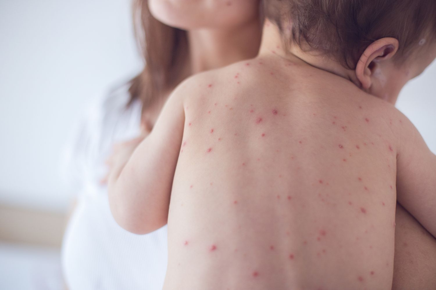 Улаанбурхан өвчний халдвар вакцины нас хүрээгүй хүүхдүүд хүндэрч, эндэх эрсдэлтэй байна